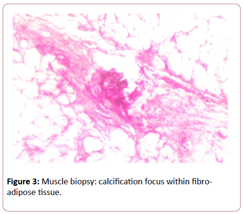 autoimmunediseases-Muscle-biopsy