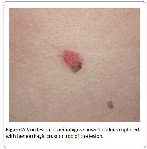autoimmunediseases-Skin-lesion