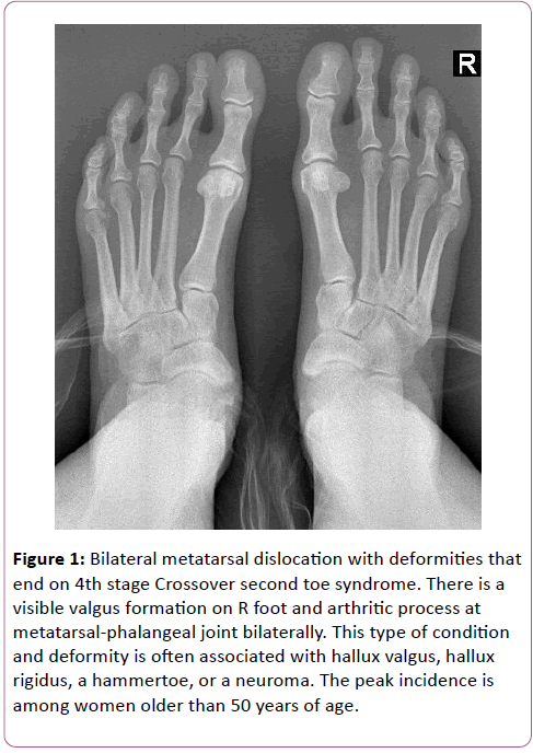 autoimmunediseases-foot-arthritic
