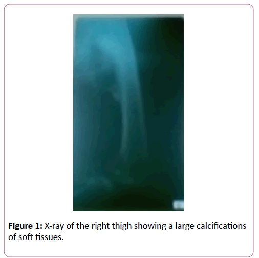 autoimmunediseases-right-thigh